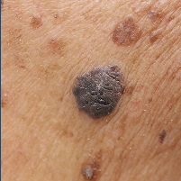 Skin Growths or Moles